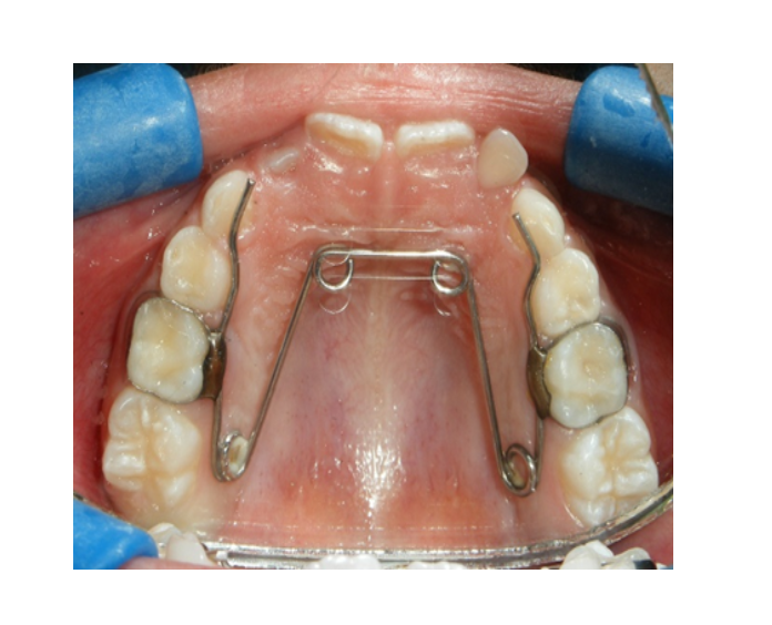 Mordida Cruzada posterior unilateral