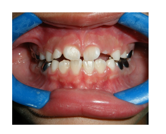 Mordida Cruzada posterior unilateral
