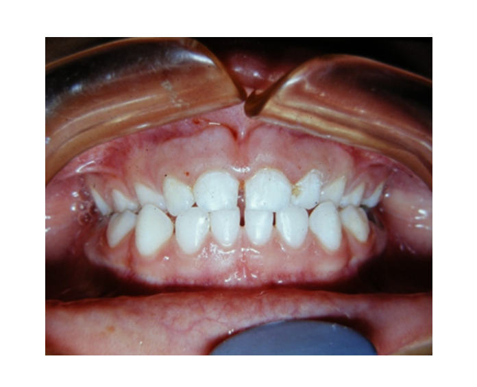 Mordida cruzada posterior bilateral