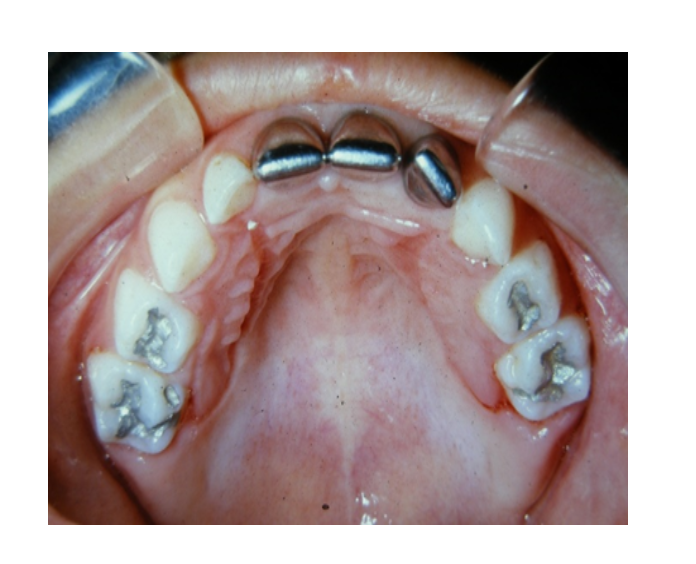 Mordida cruzada posterior bilateral