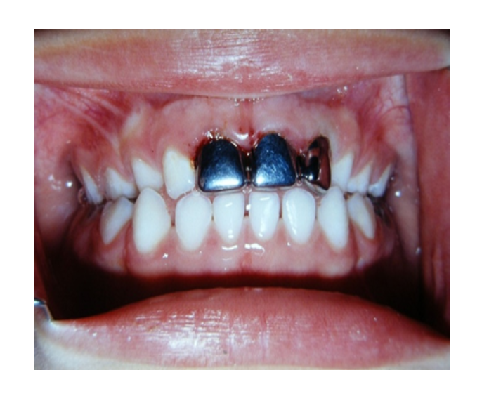 Mordida cruzada posterior bilateral