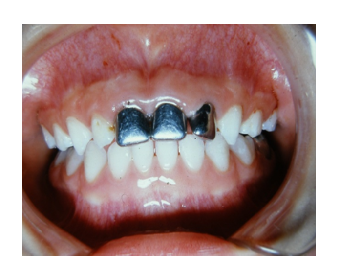 Mordida cruzada posterior bilateral