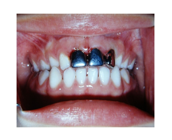 Mordida cruzada posterior bilateral