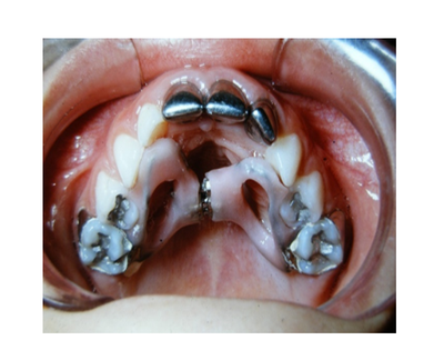 Mordida cruzada posterior bilateral