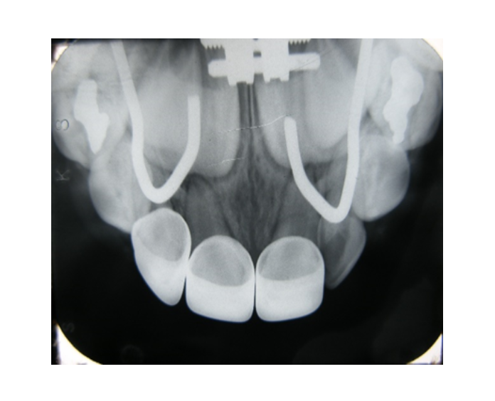 Mordida cruzada posterior bilateral