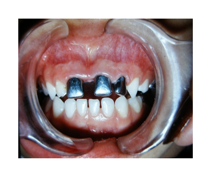 Mordida cruzada posterior bilateral