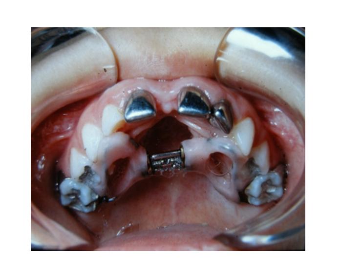 Mordida cruzada posterior bilateral