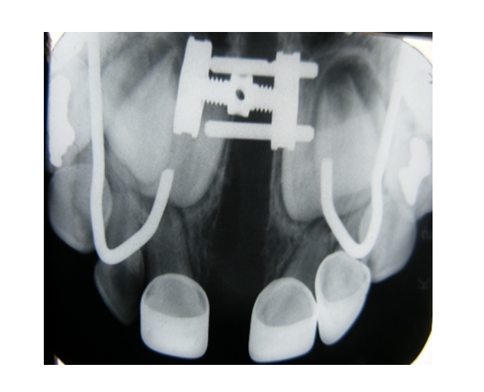 Mordida cruzada posterior bilateral