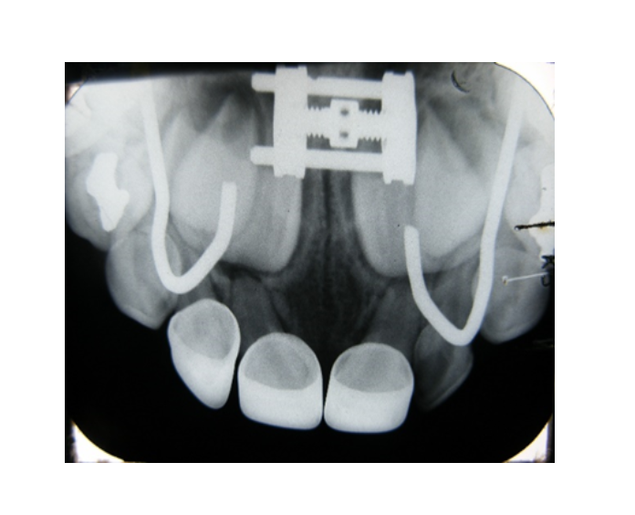 Mordida cruzada posterior bilateral