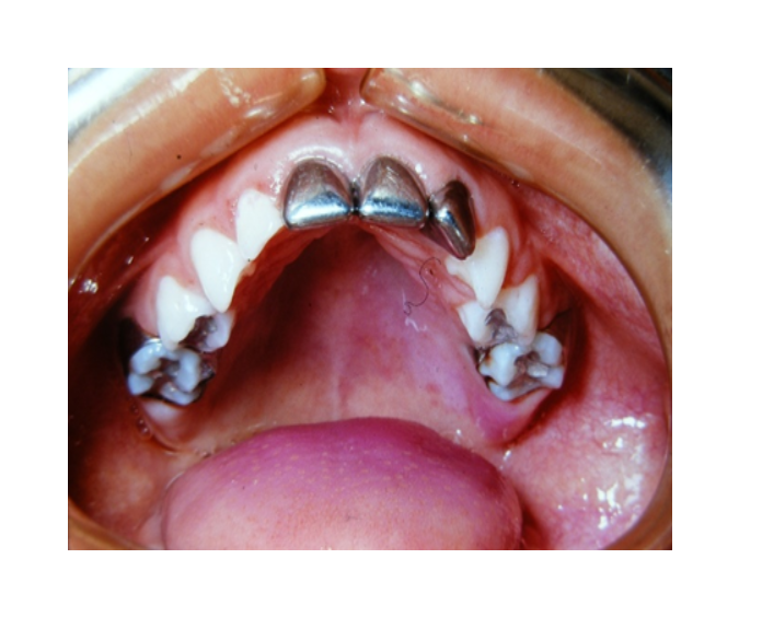 Mordida cruzada posterior bilateral
