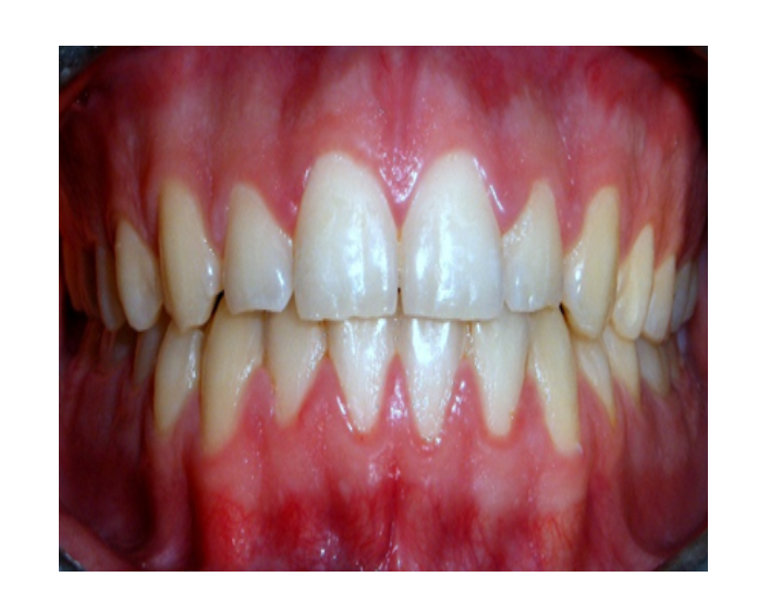 Ortodoncia en Adultos