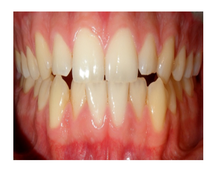 Ortodoncia en Adultos