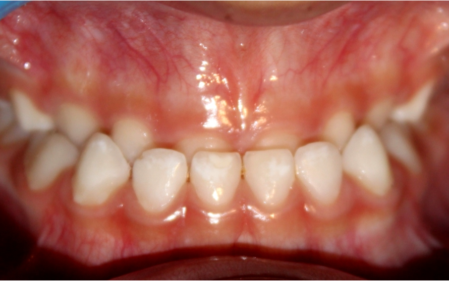 Ortopedia facial temprana