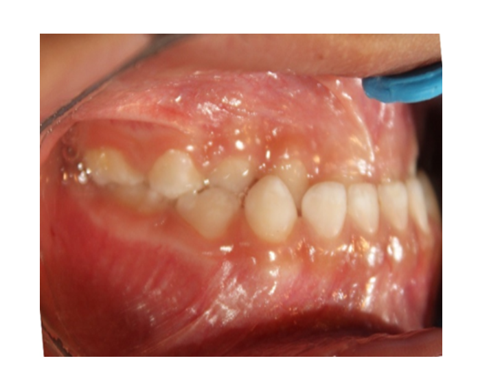 Ortopedia facial temprana