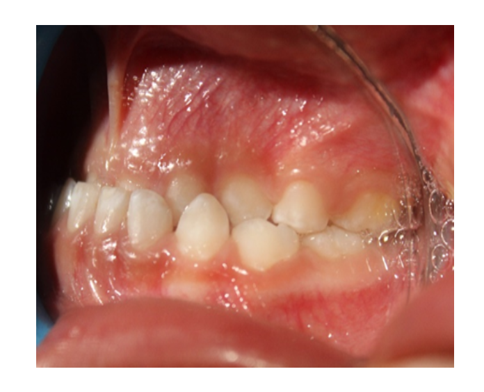 Ortopedia facial temprana