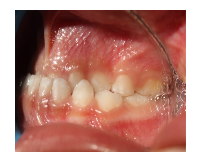 Ortopedia facial temprana