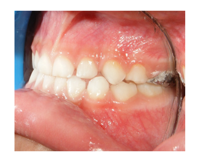 Ortopedia facial temprana