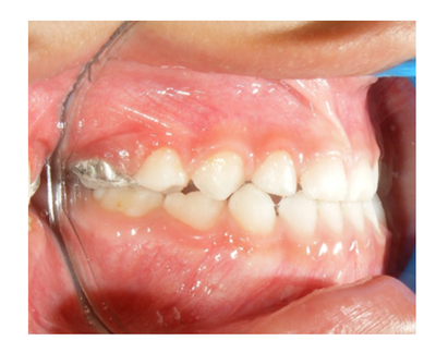 Ortopedia facial temprana