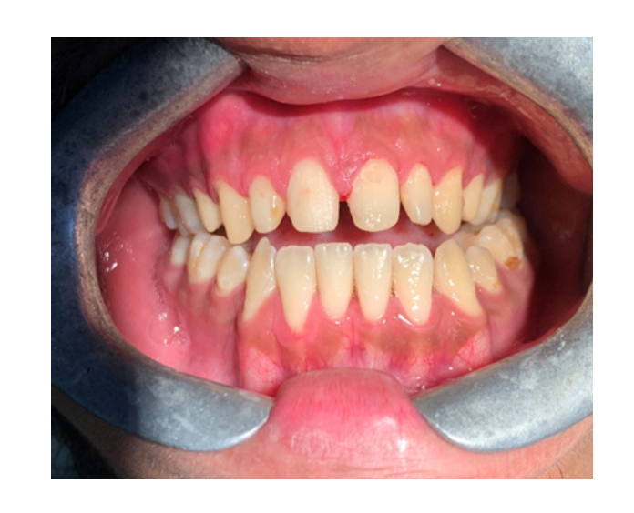 Prótesis fija de zirconia sin metal