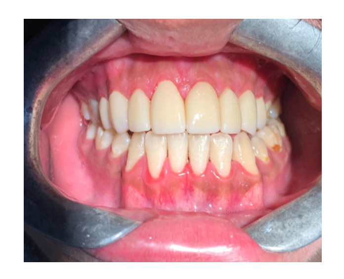 Prótesis fija de zirconia sin metal