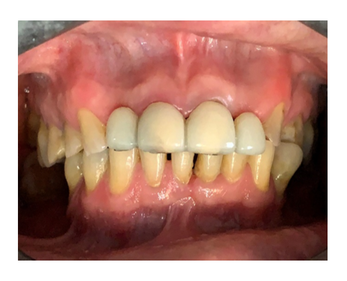 Prótesis fija de zirconia sin metal