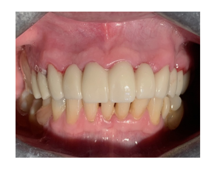 Prótesis fija de zirconia sin metal