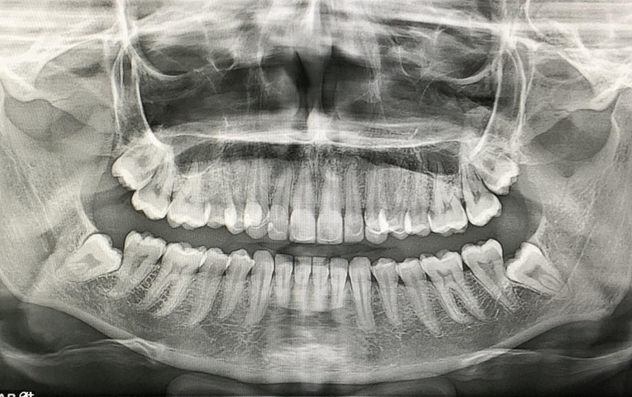 Tomógrafo Dental Ray Scan