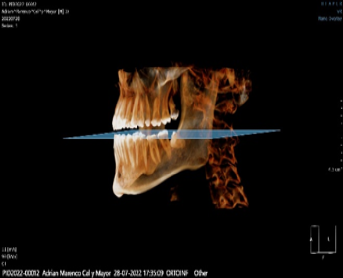 Tomógrafo Dental Ray Scan