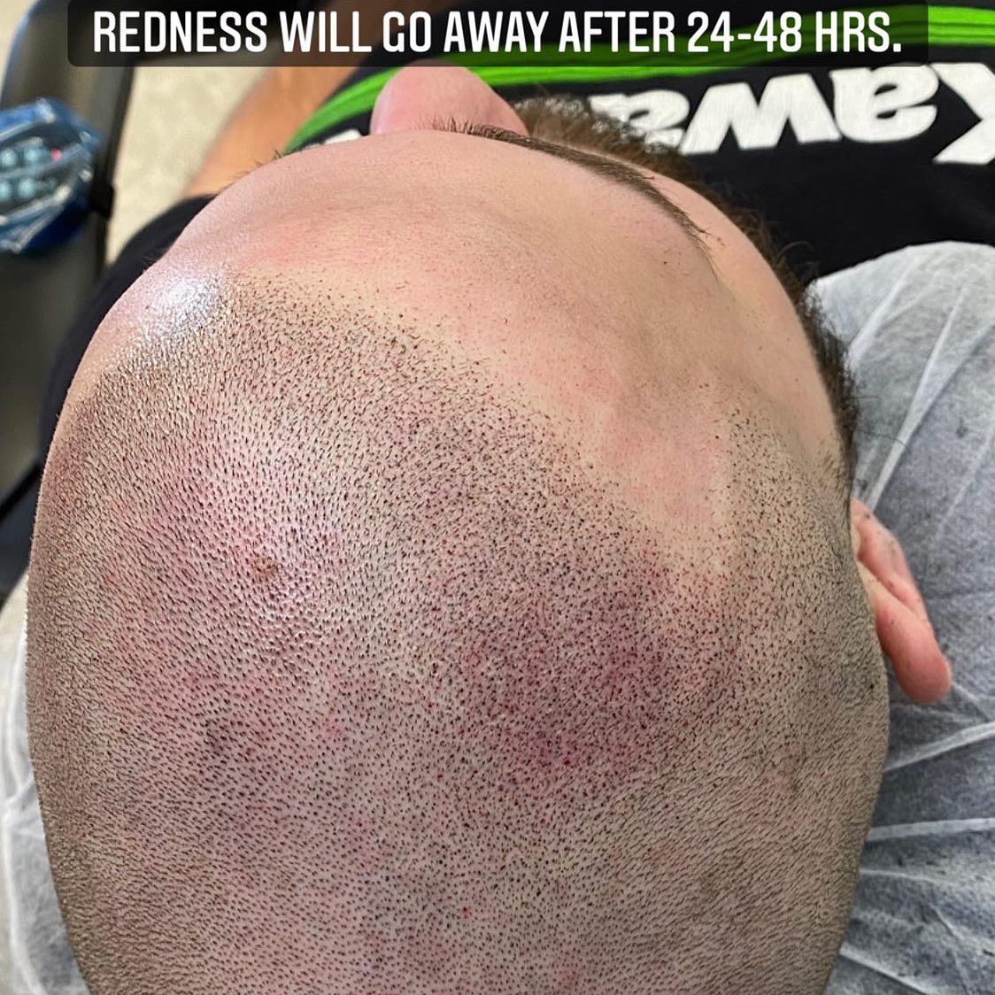 A man 's head with the words redness will go away after 24-48 hrs