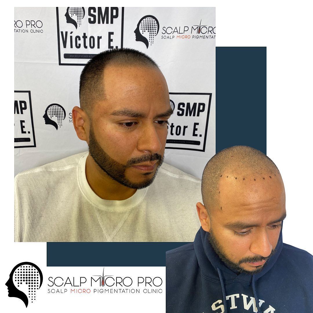 A man with a beard is getting a hair transplant.