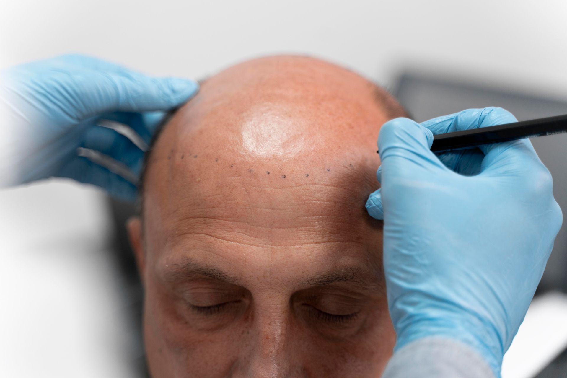 A man with a bald head is being examined by a doctor.