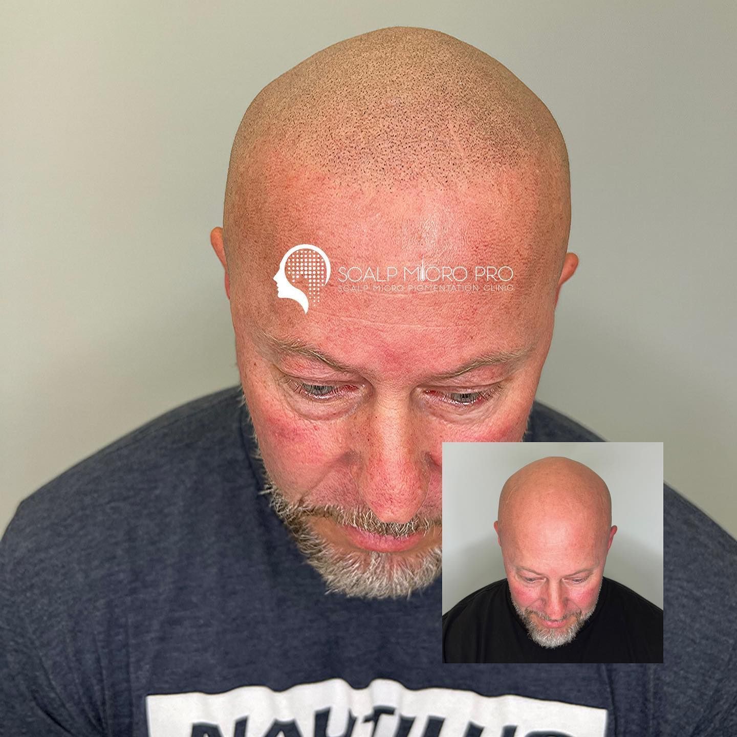 A bald man with a beard is wearing a black shirt