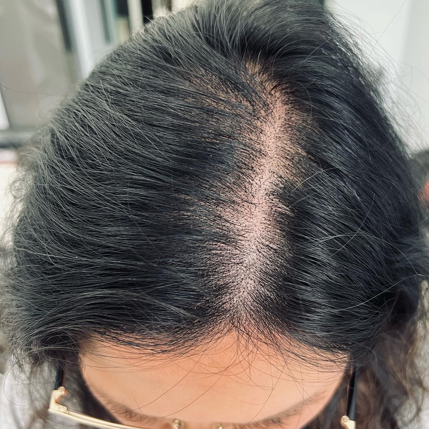 A close up of a woman 's head with a bald spot on it.