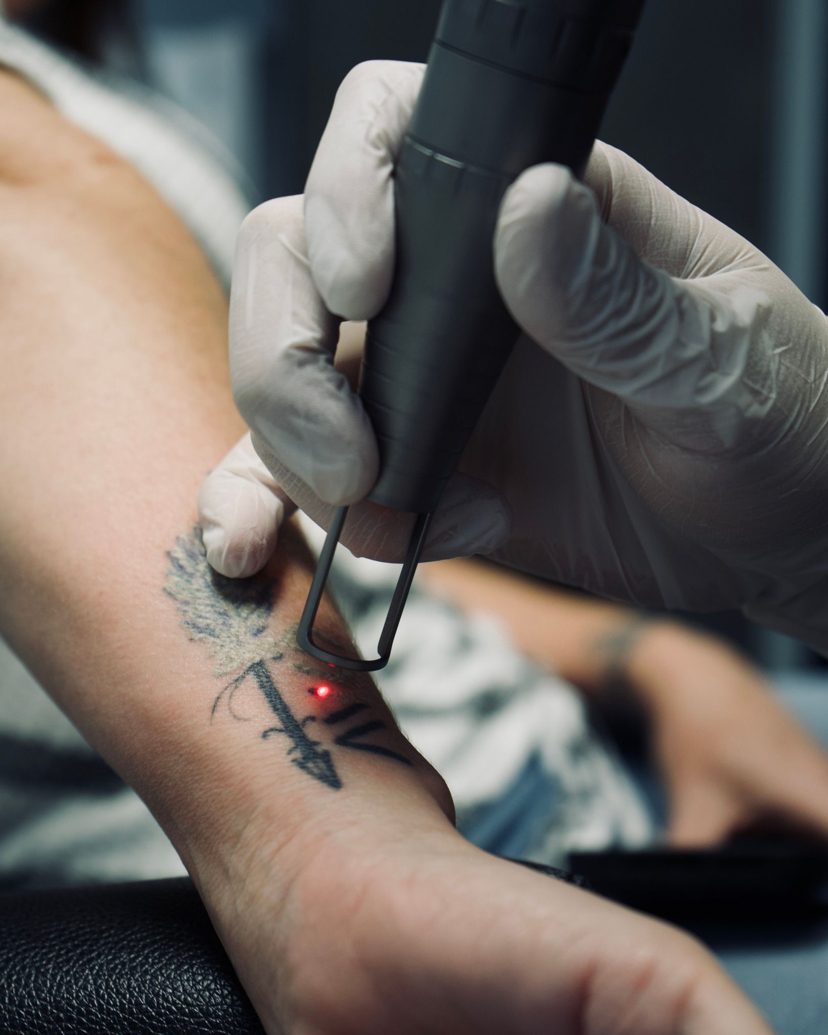 A person is getting a tattoo removed from their arm