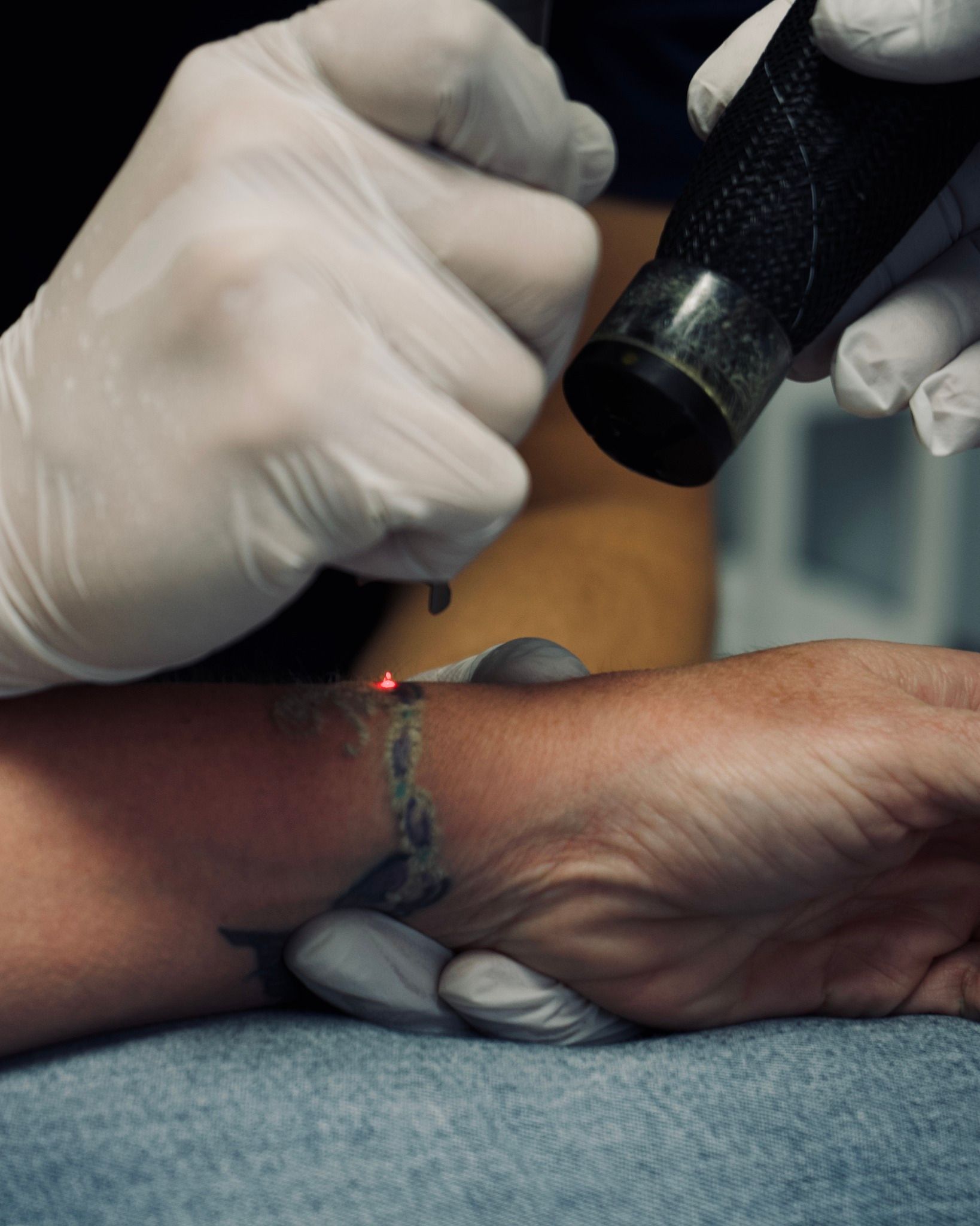 A person is getting a tattoo removed from their wrist