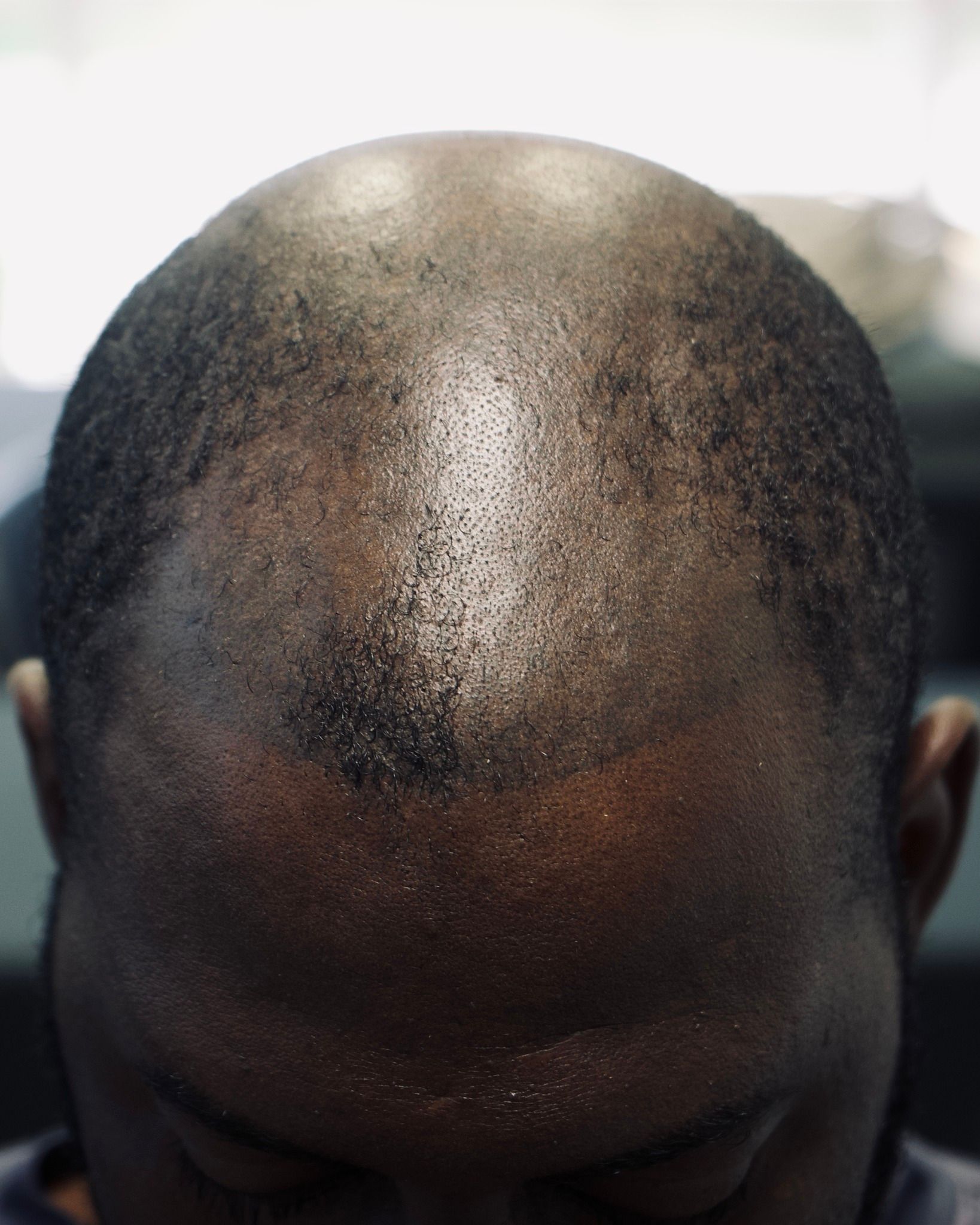 A close up of a man 's head with a bald head.