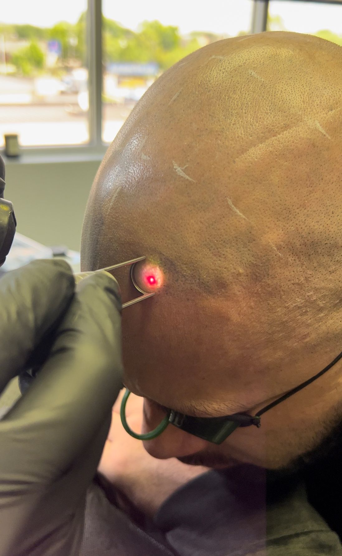 A man is getting a laser treatment on his head.