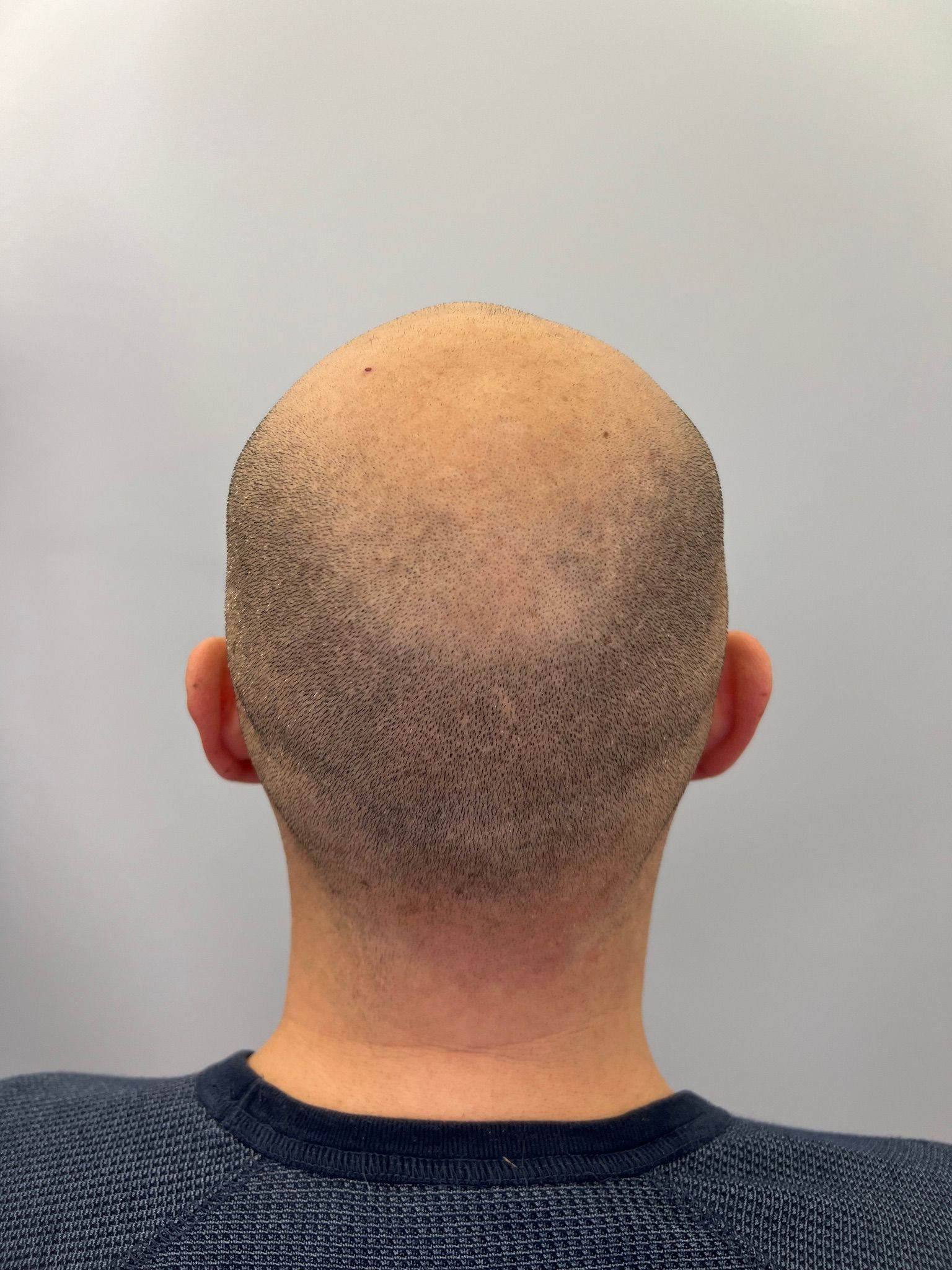 The back of a bald man 's head is shown.