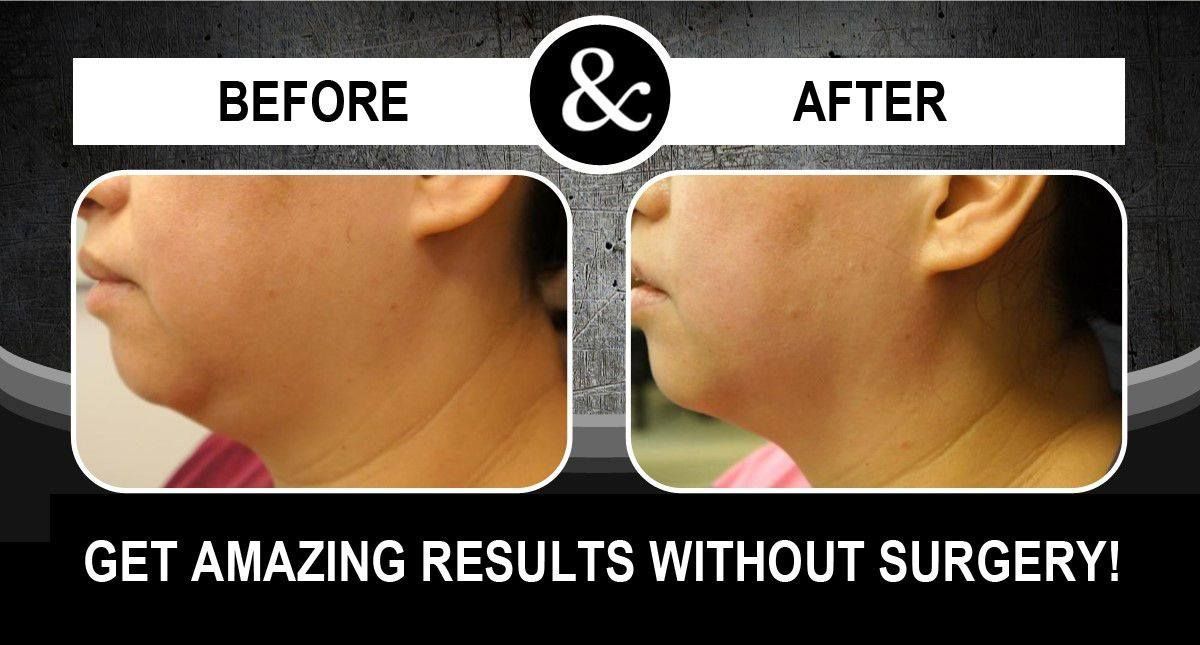 Before & after photos of a jawline, showing a reduction in fat with the headline: Get amazing results without surgery!