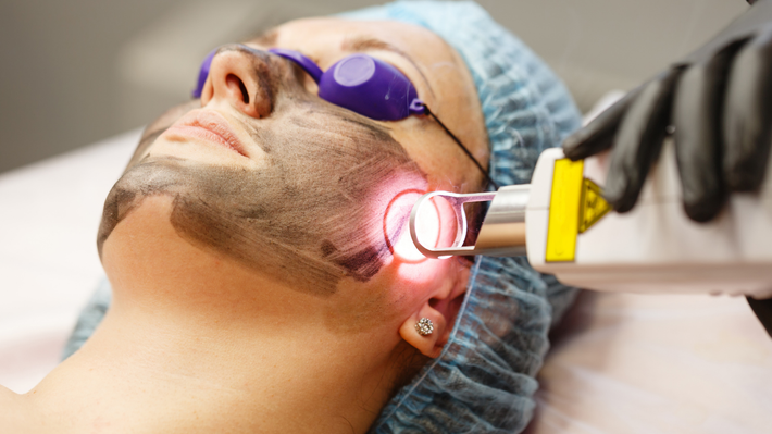 Woman undergoing a laser facial treatment with a carbon mask and protective eyewear.