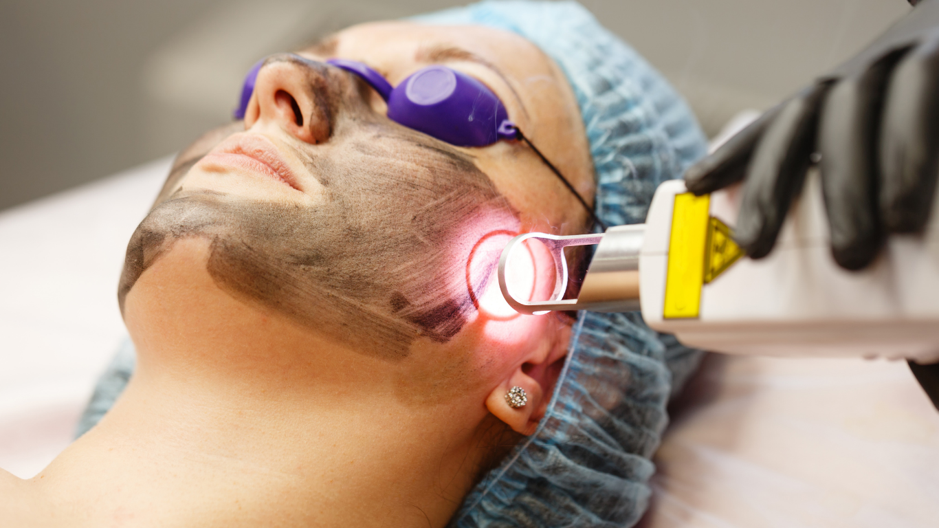 Person undergoing carbon laser facial treatment; a laser device is pointed at their cheek.