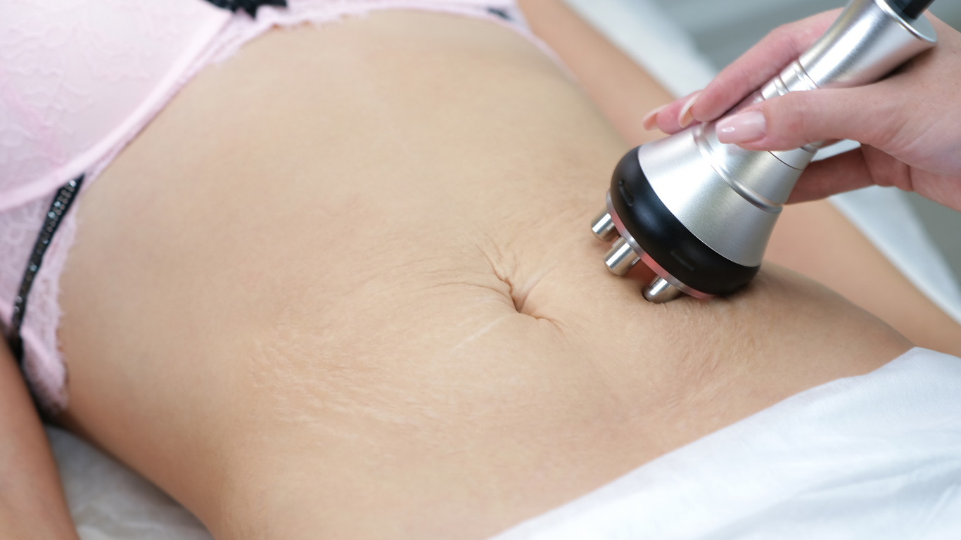 A person's abdomen receiving a body contouring treatment with a handheld device.