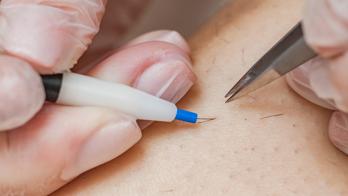 Electrolysis hair removal treatment with gloved hands using tweezers and device with a needle.