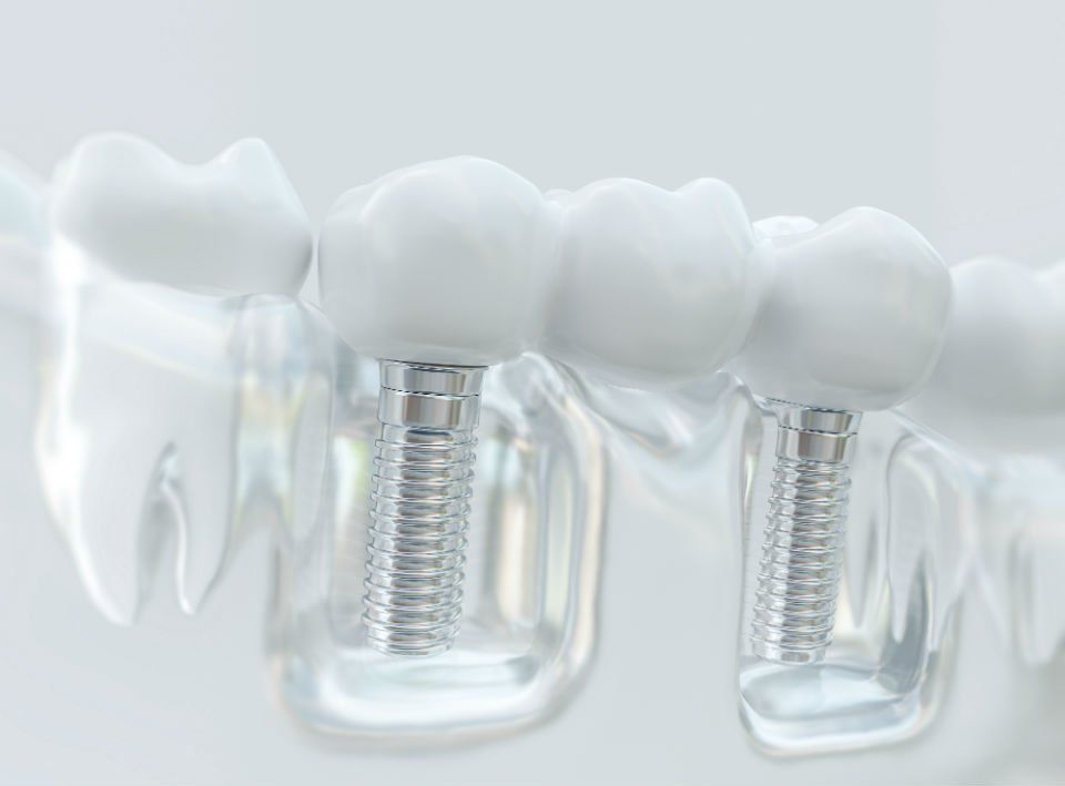 protesi fissa per denti