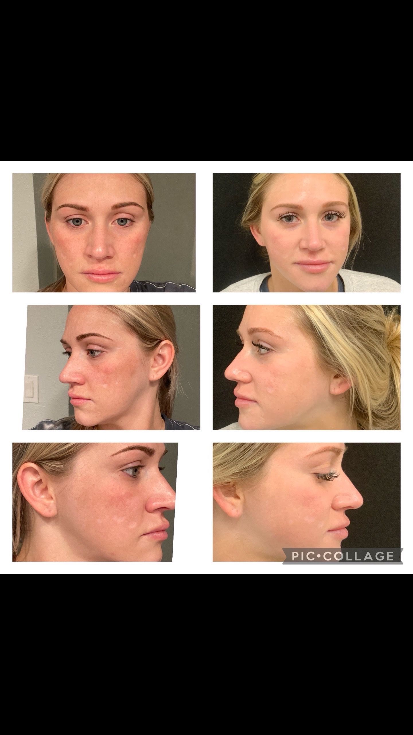 Before and after photos of a fair-skinned woman, showing skin discoloration before, and improved skin tone after treatment.