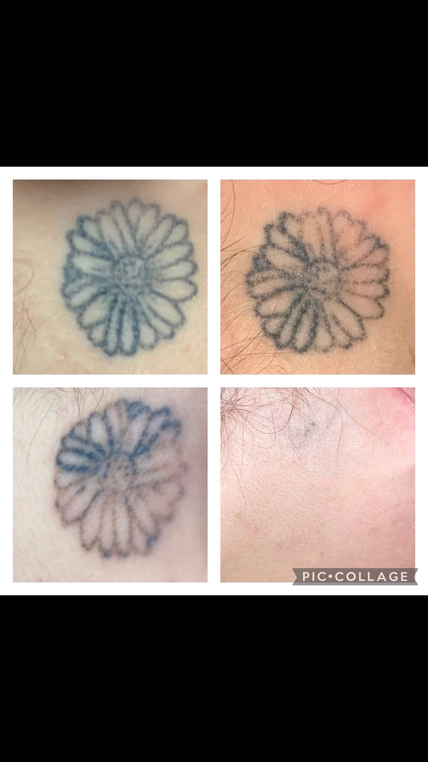 Four stages of a daisy tattoo removal: dark outline to faded, then nearly gone.