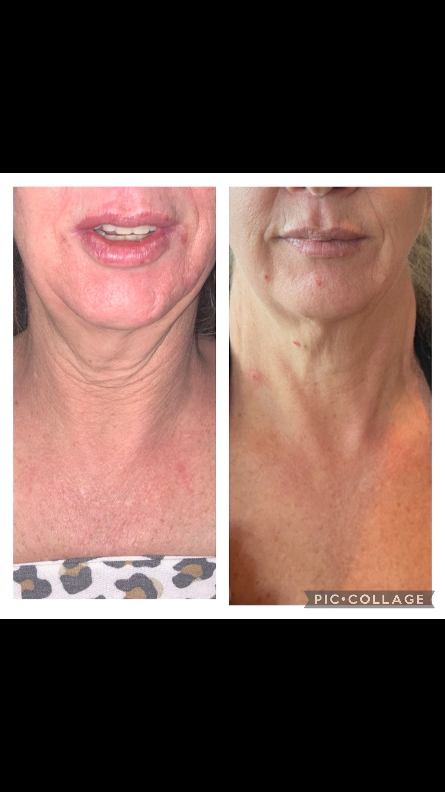 Before and after photos of a person's neck. The first shows wrinkles, the second smoother skin.