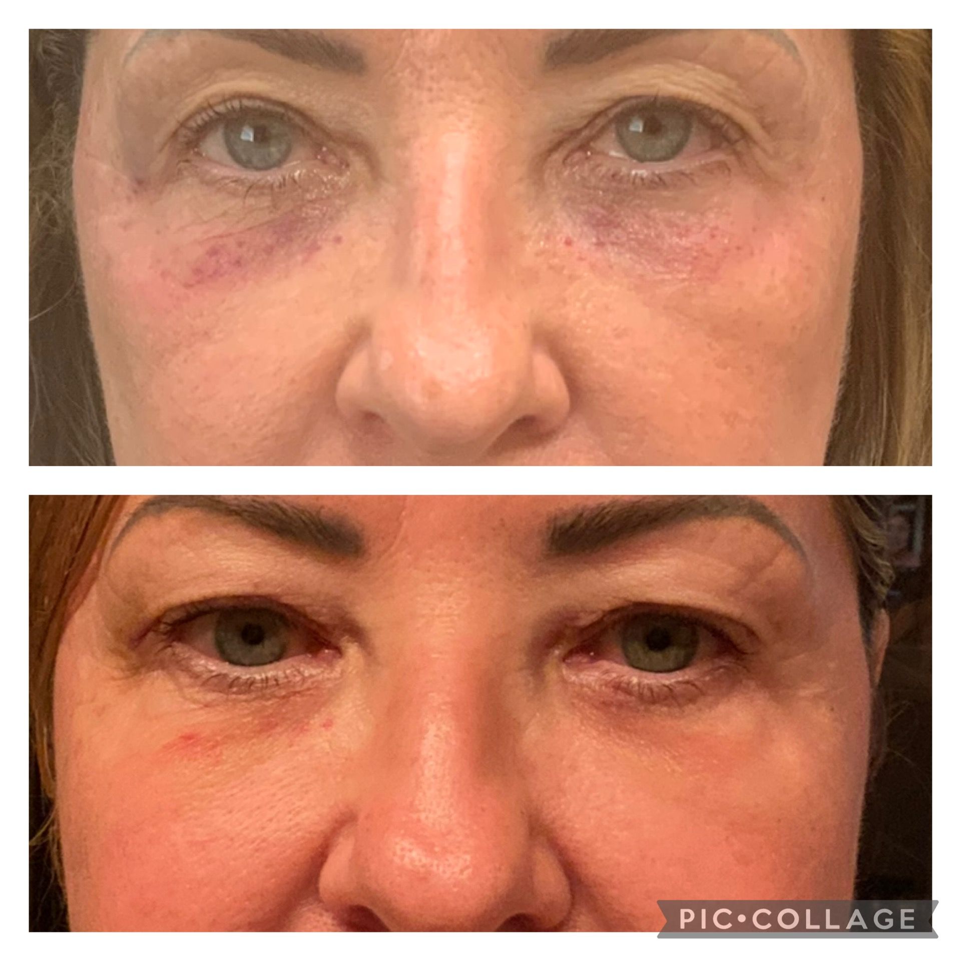 Before and after of a person's eyes, showing reduction in dark circles and bruising.