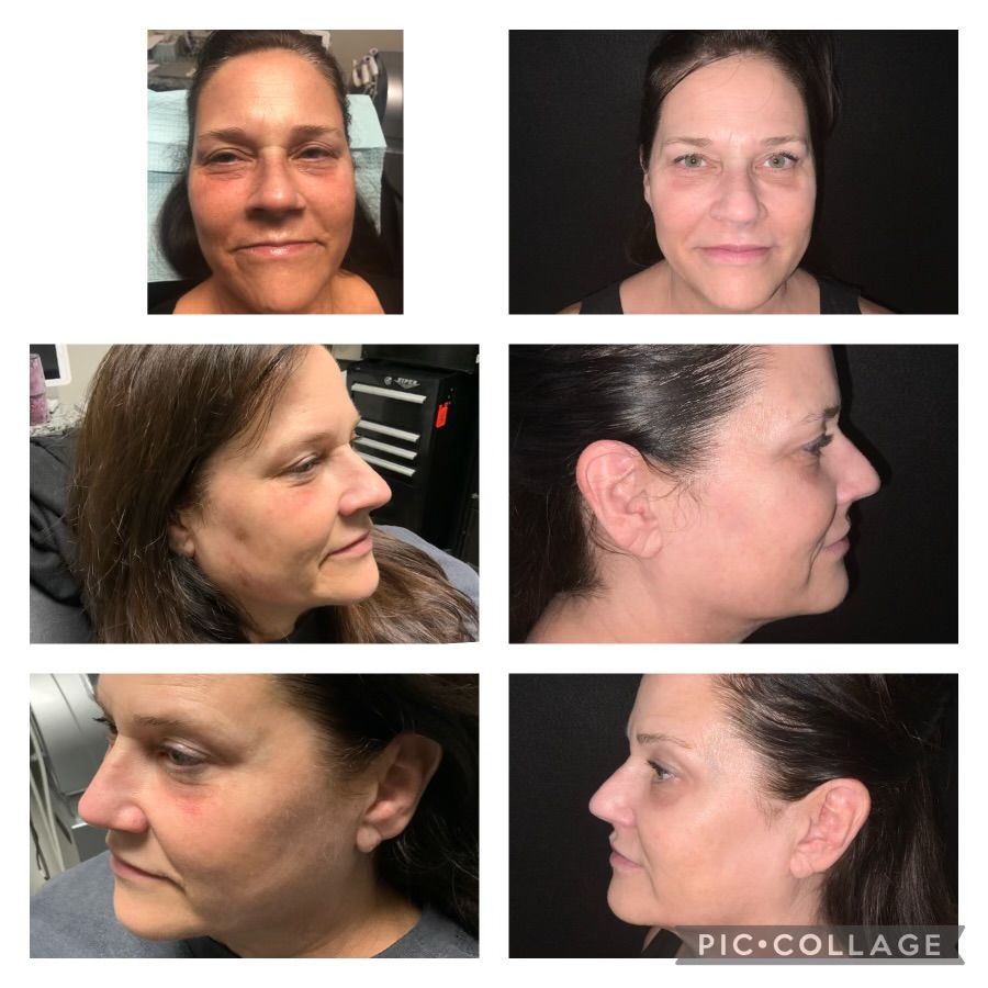 Collage of woman's face before and after cosmetic procedure. Different angles, visible swelling, dark background.