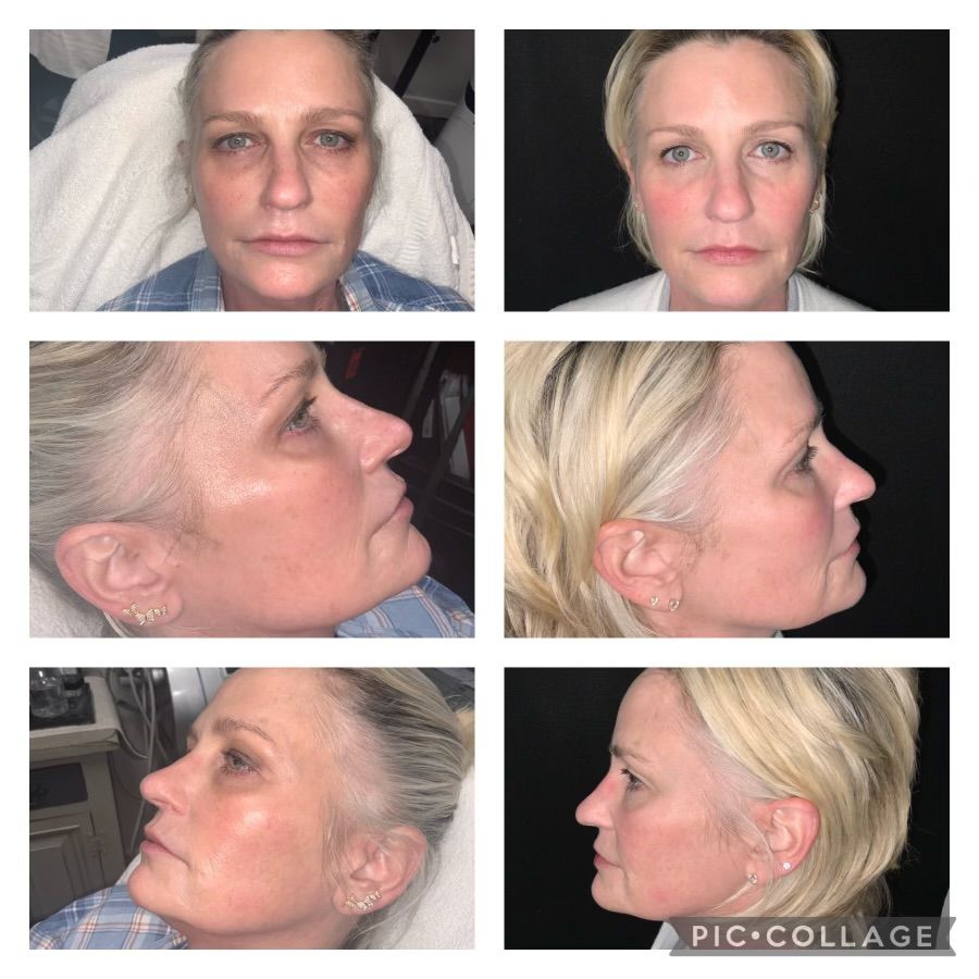 Before and after shots of a woman's face, possibly showing cosmetic procedure results.